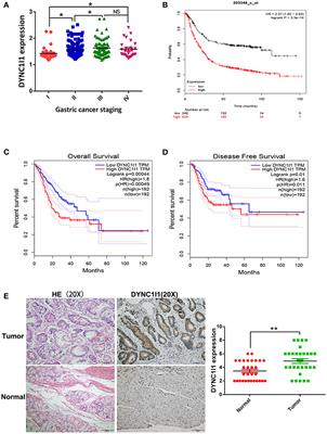 DYNC1I1 Promotes the Proliferation and Migration of Gastric Cancer by Up-Regulating IL-6 Expression